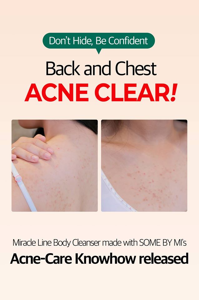 Some by Mi Miracle Acne Clear Body Cleanser from Korea 400ml